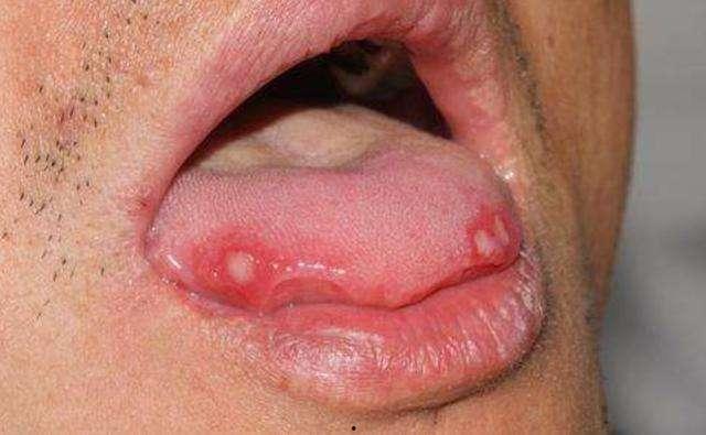吃瓜嘴有口疮,揭秘口腔健康小贴士